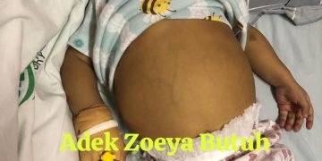 Bayi 8 Bulan di Berau Derita Atresia Bilier, Butuh Dana untuk Transplantasi Hati